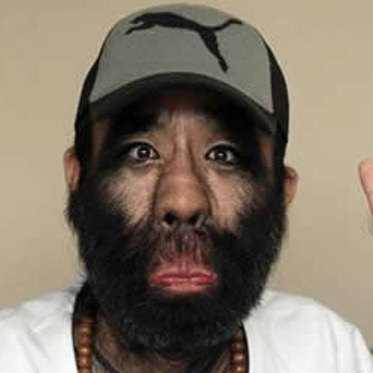 China’s Hairiest Man Undergoes Laser Treatment