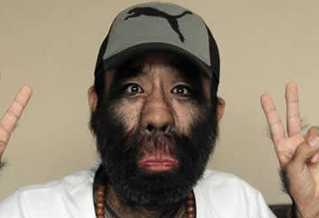 China’s Hairiest Man Undergoes Laser Treatment