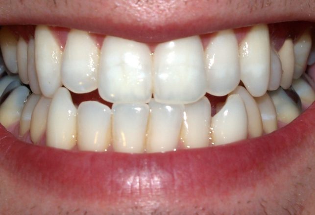 Chewing on the Evolution of Tooth Enamel