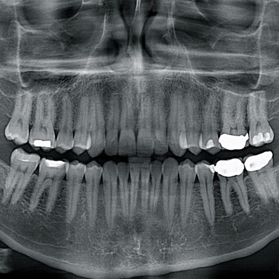 Ancient Romans Had Less Gum Disease Than We Do