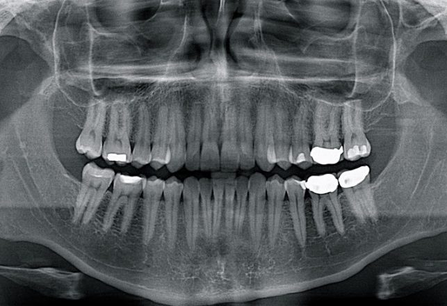 Ancient Romans Had Less Gum Disease Than We Do