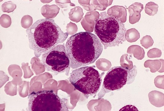 acute monocytic leukemia 570x386