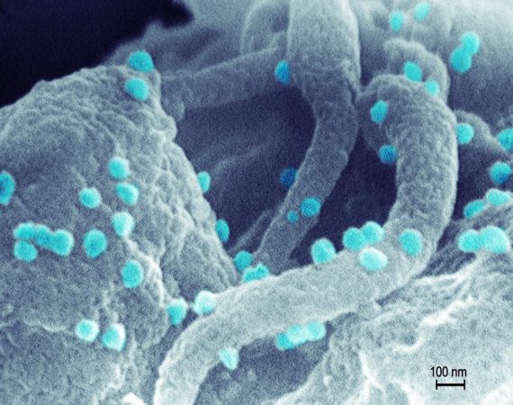 scanning electron micrograph of hiv1 570x450