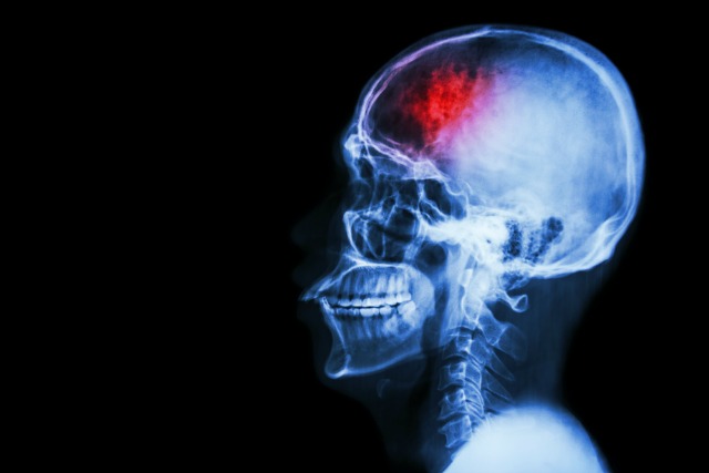 brain injury and mental illness