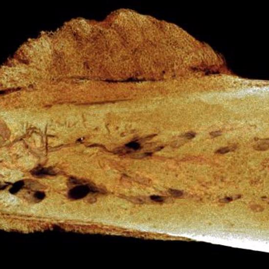 Earliest Human Cancer Dates Back 1.7 Million Years