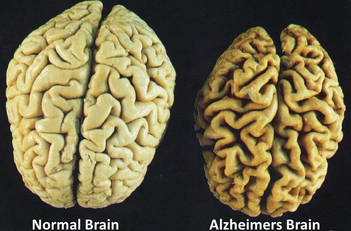 normal vs alzheimers brain e1469672524322