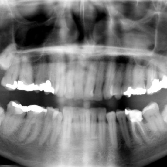 Stem Cell Dental Fillings Could Be The End of Root Canals