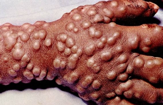 Smallpox 570x370