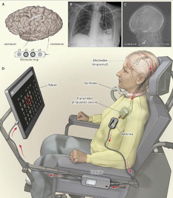 als brain implant illustration 570x654
