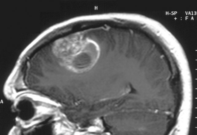 Bacteria Are Being Reprogrammed to Eat Brain Tumors