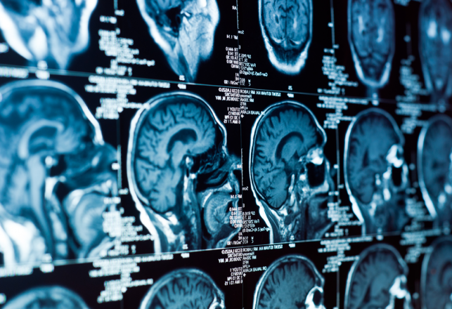 Doctors Report Cases of Anomalous Brain Activity After Death