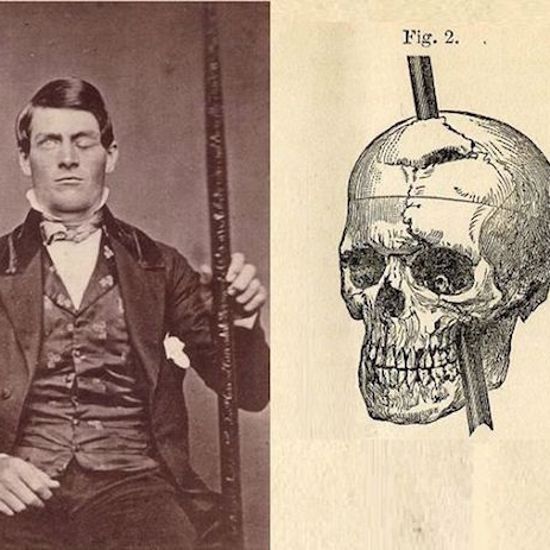 The Curious Case of Phineas Gage