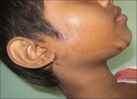 Hematohidrosis Indian Journal Dermatology Dermatol 2013 58 6 478 119964 f1 570x412