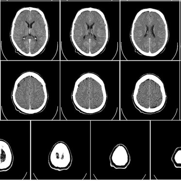 The Human Mini-Brains Are Back and They’re Better Than Before